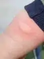 Stroking the skin leads to a localised subcutaneous anaphylactoid reaction with mast cell degranulation and urticarial rash