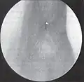 Grade 4 subglottic stenosis