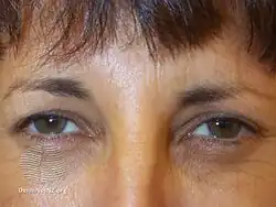 Subject attempting to frown after botulinum toxin injections