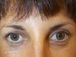 Subject relaxed after botulinum toxin injections