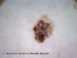 Superficial spreading melanoma, Breslow 0.5 mm, nonpolarised dermoscopy view