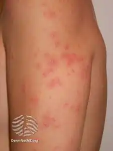 Swimmers itch