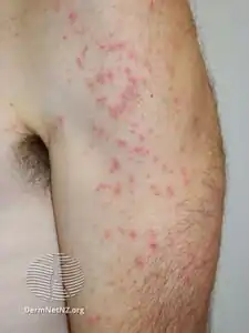 Swimmers itch