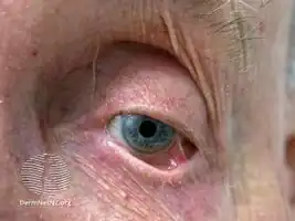 Symblepharon due to cicatricial pemphigoid