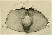 Large rectocele