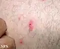Tick bite