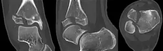CT scan