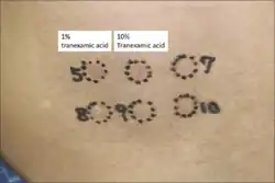 Patch test to tranexamic acid