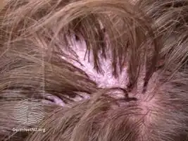 Tufted folliculitis