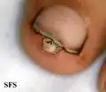 Burrow in Tungiasis