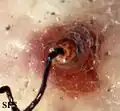 Burrow in Tungiasis
