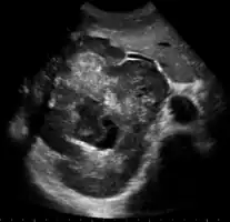Large HCC filling almost entire of right lobe