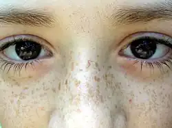 Freckles