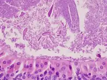 Histopathology of Warthin tumor in the parotid gland. Higher magnification of a Fig 1