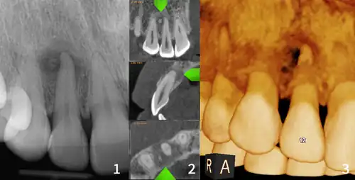 xray and CBCT scans of periapical cemental dysplasia