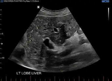 von Meyenburg Complex in ultrasound. Numerous little cysts with ringdown artefacts.