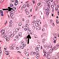 Acinar adenocarcinoma with double and eccentric nucleoli.